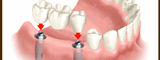 Replacing Teeth