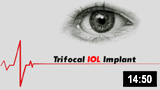 Trifocal IOL Implant 
