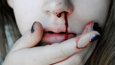 <br>Nose Bleeds - Epistaxis